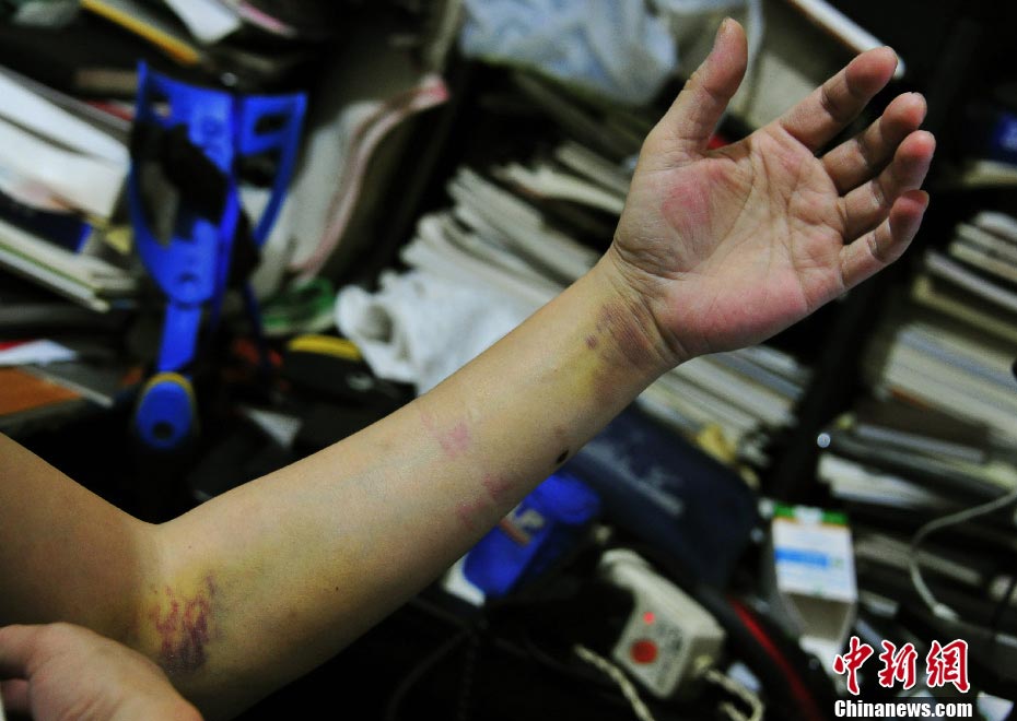 Duan's arm could not stop bleeding, although he took the "clotting factor" injection. (Photo/CNS)