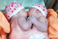 Conjoined twins separated in groundbreaking surgery